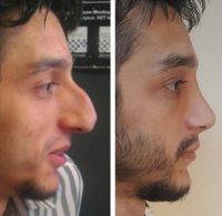 Male Rhinoplasty Can Radically Change The Appearance Of Your Face