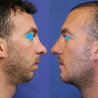 Male Rhinoplasty O Re-shape A Man's Nose