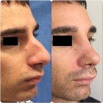 Male Rhinoplasty Pictures (1)