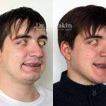 Male Rhinoplasty Pictures (2)