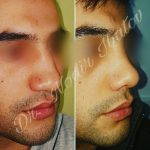 Male Rhinoplasty Tends To Increase Confidence Or Boost Self-esteem
