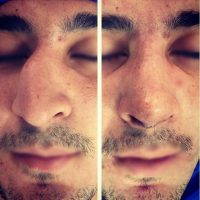 Male Rhinoplasty To Refine The Shape Of The Nose