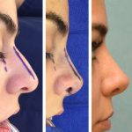 Nose Bump Deviated Septum Before And After Photos (2)