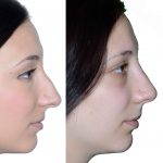 Nose Bump Fix Before And After (2)