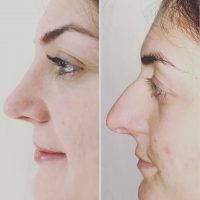 Nose Bump Removal Surgery Can Make A Significant Difference In The Whole Appearance Of The Face