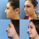 Nose Bump Surgery Can Correct A Wide Variety Of Nasal Issues, Including A Humped Or Wide Bridge