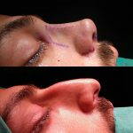 Nose Bump Surgery For Man (2)