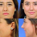 Nose Surgery For Bump Photos (2)