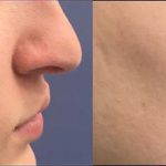 Nostril Correction Surgery Involves Placement Of An Incision Around The Alar Insertion Inside The Nostril
