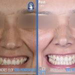 Nostril Cosmetic Surgery (5)