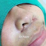 Nostril Flare Surgery (2)