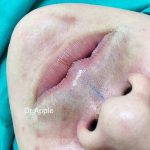 Nostril Reduction Surgery Before And After (4)