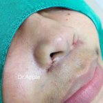 Nostril Slimming Surgery