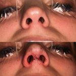Nostril Surgery Can Dramatically Reduce The Width Of The Lower Nose