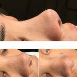 Nostril Surgery Can Reduce The Length Of Your Nostril Sidewalls