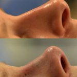 Nostril Surgery For Nostrils That Are Large, Wide, Or Upturned