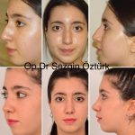 Nostril Surgery If The General Width Of The Nose Does Not Compliment Your Overall Facial Features