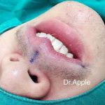 Nostril Surgery Is A Common Request From Individuals Who Feel That Their Nostrils Are Too Wide