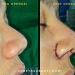 Nostril Surgery Reduction (2)