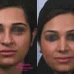 Persian Nose Job Before And After Pictures (3)