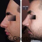 Persian Nose Jobs Before And After Photos (2)