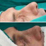 Photos Of Male Rhinoplasty Surgery (2)