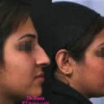 Photos Of Persian Nose Job Before And After (3)