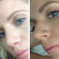 Plastic Surgery For Nose Is The Most Difficult Of All Facial Plastic Surgical Procedures
