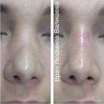 Procedure Fixing A Deviated Septum Before And After Photos (2)