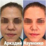 Procedure Fixing A Deviated Septum Before And After Photos (3)