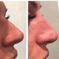 Radiesse Allows The Nose To Be Reshaped Without Surgery