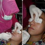 Radiesse Rhinoplasty Is A Permanent, Minimally Invasive, Non-surgical Nose Reshaping Procedure