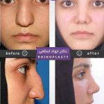 Rhinoplasty Big Nose Before After (7)