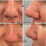 Rhinoplasty Big Nose To Small Nose Preop An Postop (1)