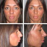Rhinoplasty Big Nose To Small Nose Preop An Postop (10)