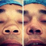 Rhinoplasty Big Nose To Small Nose Preop An Postop (11)