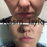 Rhinoplasty Big Nose To Small Nose Preop An Postop (4)