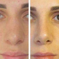 Rhinoplasty For A Nose That Hooks At The End Near The Tip Of The Nose