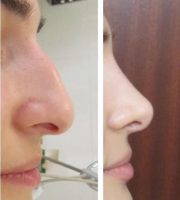 Rhinoplasty For Big Nose If Your Nose Is Wide At The Tip, Nostrils, Or Bridge