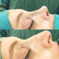 Rhinoplasty Nostrils Is A Very Effective Surgical Solution For Changing The Size Or Reshaping Your Nose