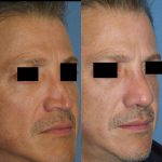 Rhinoplasty Nostrils To Correct Disfigurement Resulting From Trauma Or Birth Defects