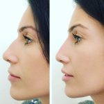 Rhinoplasty Nostrils Will Change The Nose's Shape And Appearance
