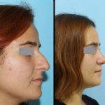 Rhinoplasty Wide Nostrils Before And After