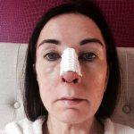 Septoplasty Before And After Photos (9)