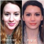 Septorhinoplasty And Rhinoplasty Before And After (11)