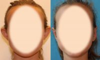 17 or under year old woman treated with Otoplasty