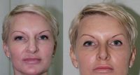 26 Years Female After 3 Months Of Closed Rhinoplasty Before With Doctor Ashok Govila, FRCS, MCh, MS, Dubai Plastic Surgeon