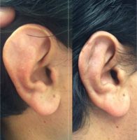 25-34 year old man treated with Ear Surgery