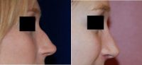34 Year Old Woman Treated With Rhinoplasty Before With Doctor Albert W. Chow, MD, San Francisco Plastic Surgeon