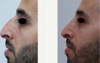 41 Year Old Man Treated With Rhinoplasty Before By Dr. Levente S. Deak, MD, PhD, Dubai Facial Plastic Surgeon